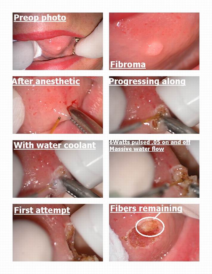 Fibroma removal pg 1.jpg